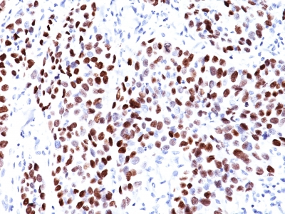 FFPE human lung squamous cell carcinoma (scc) sections stained with 100 ul anti-p21WAF1 (clone CIP1/823) at 1:50. HIER epitope retrieval prior to staining was performed in 10mM Citrate, pH 6.0.